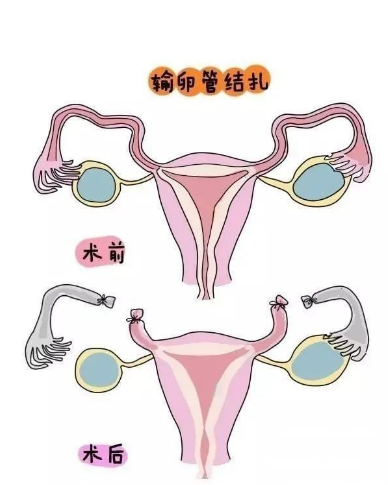 女性結(jié)扎最新方法，探索與理解